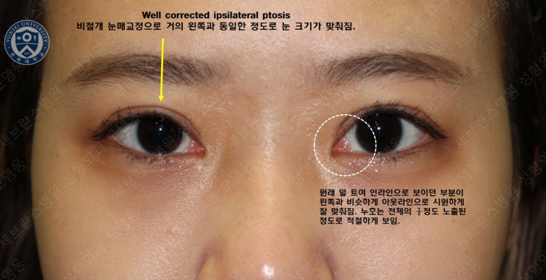 17세 여성, 비절개 눈매교정 및 앞트임 재수술 (17/F NI ptosis correction & Med. epicanthoplasty revision) 증례 관련 이미지 17