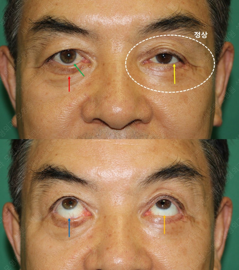 68세 남성, 하안검 성형술 및 안검외반 교정 증례(68/M Lower blepharoplasty & Ectropion correction with triamcinolone) 관련 이미지 13