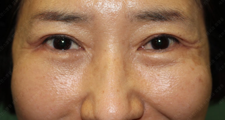 55세 여성, 상안검 및 하안검 성형술 증례 (55/F Upper & lower blepharoplasty) 관련 이미지 29