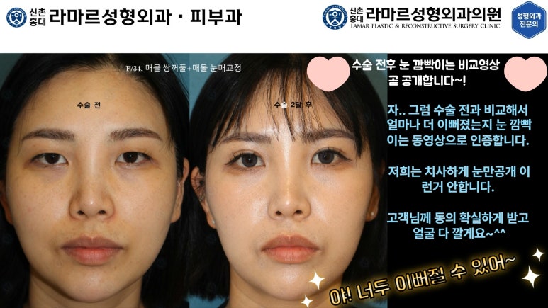 30대 여성 "쌍꺼풀+눈매교정" 상담, 디자인, 수술 전체 과정, 결과, 경과 모두 공개합니다. 관련 이미지 43