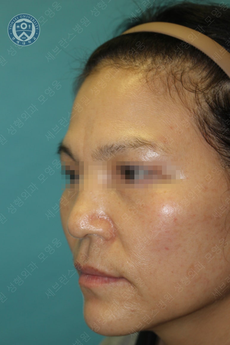 55세 여성, 이중평면 안면거상(55/F, Dual-plane full facelift) 관련 이미지 38