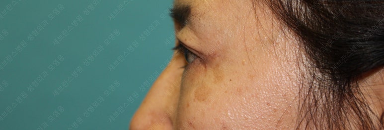 55세 여성, 상안검 및 하안검 성형술 증례 (55/F Upper & lower blepharoplasty) 관련 이미지 23