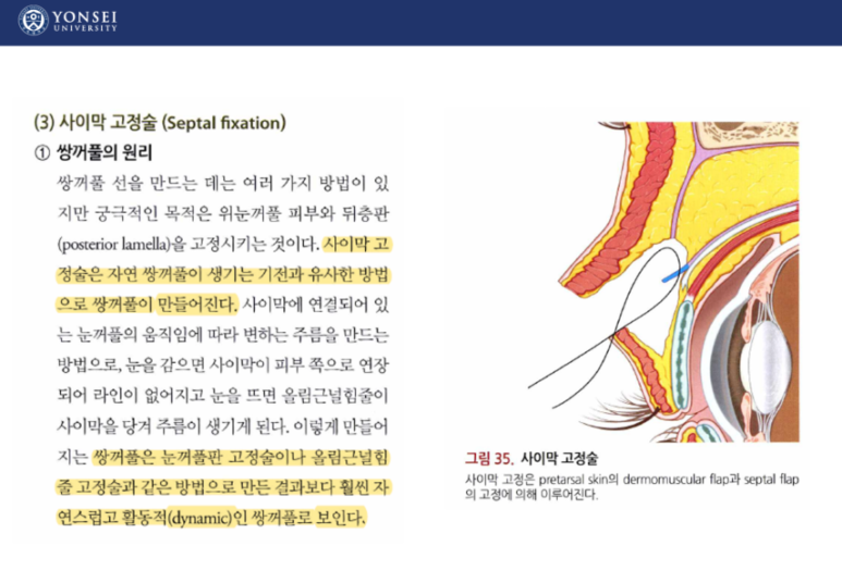 60세 여성, 상안검 및 하안검 성형술 증례 (60/F Upper & lower blepharoplasty) 관련 이미지 10