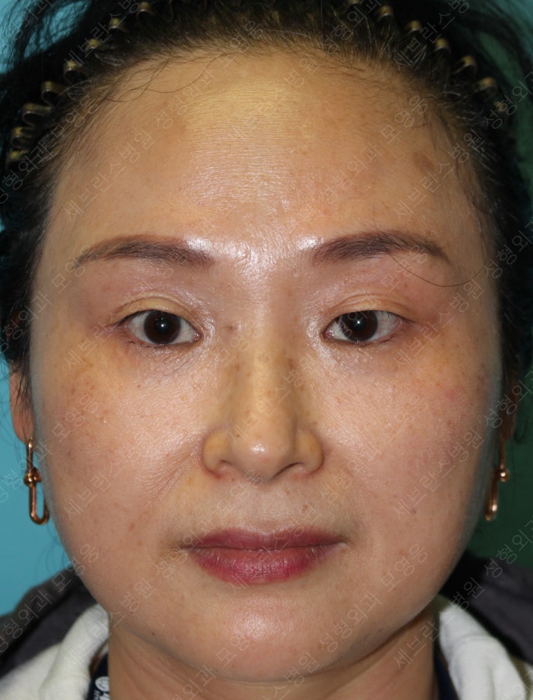 49세 여성, 토안이 있는 중년여성의 상안검성형술 (49/F, Upper blepharoplasty with lagophthalmos correction& LP) 관련 이미지 2