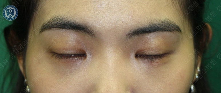 28세 여성, 눈밑지방재배치(눈밑지, 28/F Transconjunctival septal fat redraping-internal fixation technique) 관련 이미지 19