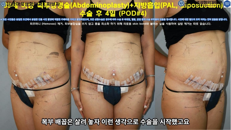 '복부성형술+지방흡입(Abdominoplasty+PAL)' 으로 뱃살 끝장내기! 관련 이미지 41