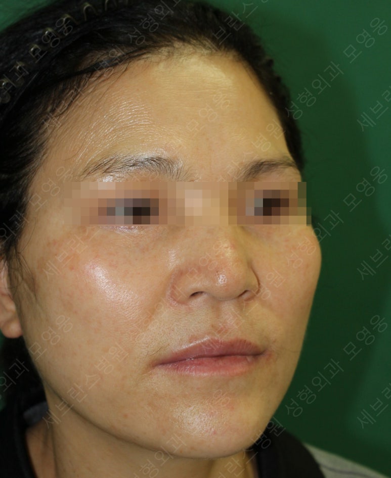 55세 여성, 이중평면 안면거상(55/F, Dual-plane full facelift) 관련 이미지 53