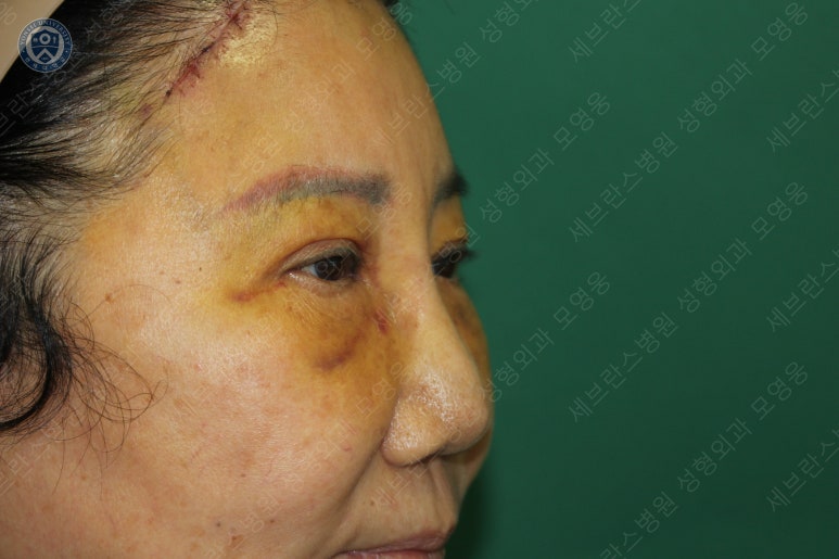 71세 여성, 이마거상술과 이마축소술 (71/F, Forehead lift and reduction) 관련 이미지 26