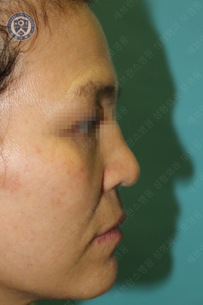 55세 여성, 이중평면 안면거상(55/F, Dual-plane full facelift) 관련 이미지 40
