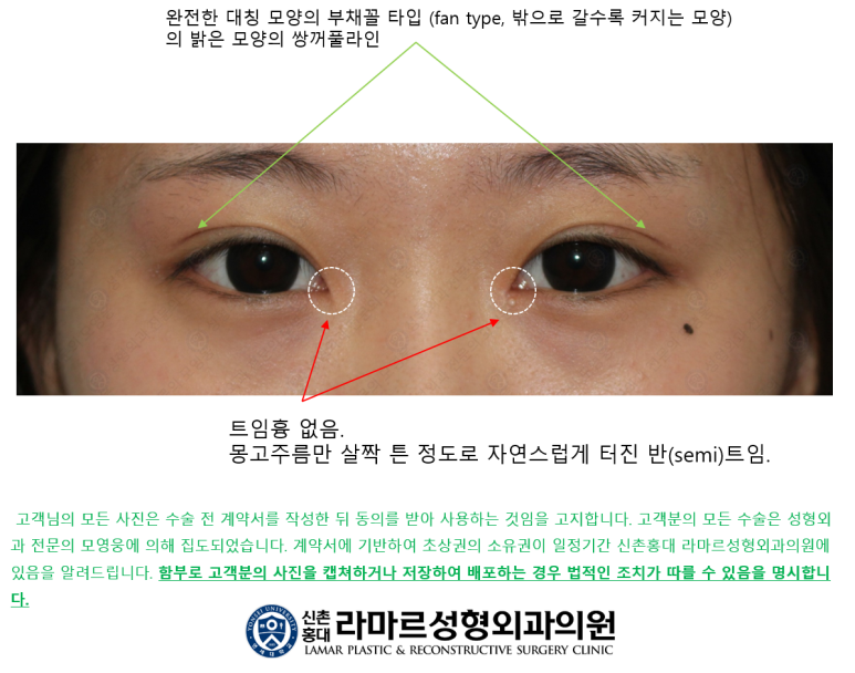 17세 여성, 쌍꺼풀+앞트임(DEO+Medial epicanthoplasty) 관련 이미지 41