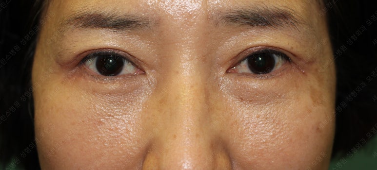 55세 여성, 상안검 및 하안검 성형술 증례 (55/F Upper & lower blepharoplasty) 관련 이미지 27