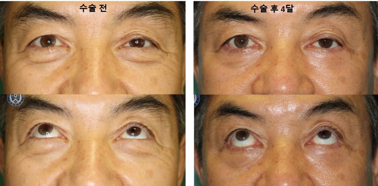 68세 남성, 하안검 성형술 및 안검외반 교정 증례(68/M Lower blepharoplasty & Ectropion correction with triamcinolone) 관련 이미지 26