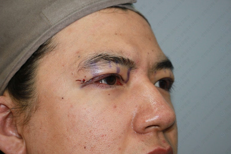 27세 남성 무쌍(속쌍)눈매교정 (27/M Ptosis correction with double lid plasty) 관련 이미지 19