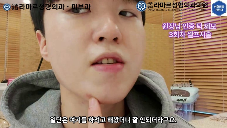 [성형외과 전문의의 셀프시술 제8편] 인중, 아래턱 제모 4회차 결과 공개! 관련 이미지 43