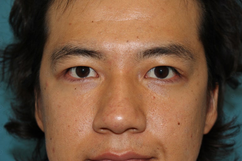 27세 남성 무쌍(속쌍)눈매교정 (27/M Ptosis correction with double lid plasty) 관련 이미지 30