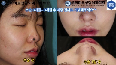 21세 여성 코 지름 1cm 점 제거수술 : 나선피판술(Spiral Flap) 수술전~5달 경과. (+쌍꺼풀수술, 코필러) 관련 이미지 7