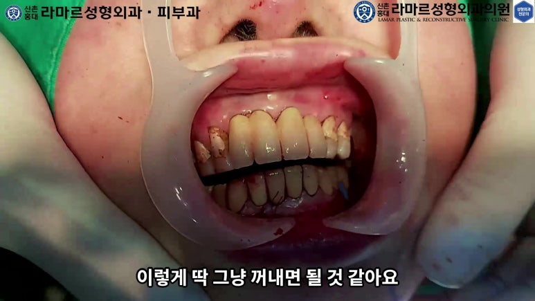 파라핀 필러 입 안 절개로 흉터없이 빼내기! 관련 이미지 84