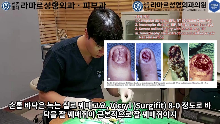 손가락 힘줄 손상 및 열상, 손톱 바닥 열상 처치 (Extensor tendon repair and nailbed injury treatment) 관련 이미지 22