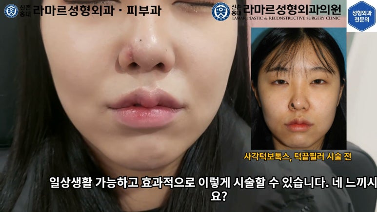 지름 1cm 코 점 제거수술 : 나선피판술(Spiral Flap) 수술전~1달 경과. (Feat. 턱끝필러+사각턱 보톡스) 관련 이미지 161