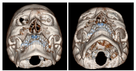 57세 남성, 얼굴 전체골절(57/M Panfacial bone fracture) 수술 및 흉터관리 증례 관련 이미지 5