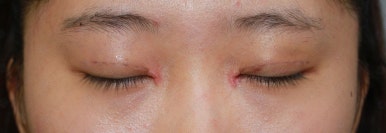 17세 여성, 쌍꺼풀+앞트임(DEO+Medial epicanthoplasty) 관련 이미지 15