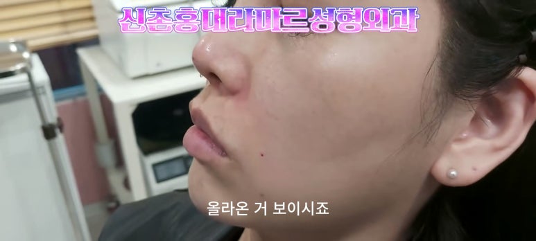30대 여성 팔자필러 시술: 팔자주름과 안전이별 하는 법 관련 이미지 8