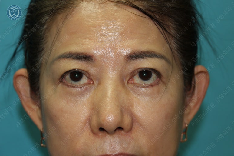 59세 여성, 그레이브스 안병증이 있는 돌출눈 중년 여성 하안검 성형술 (Lower blepharoplasty in Graves 관련 이미지 36