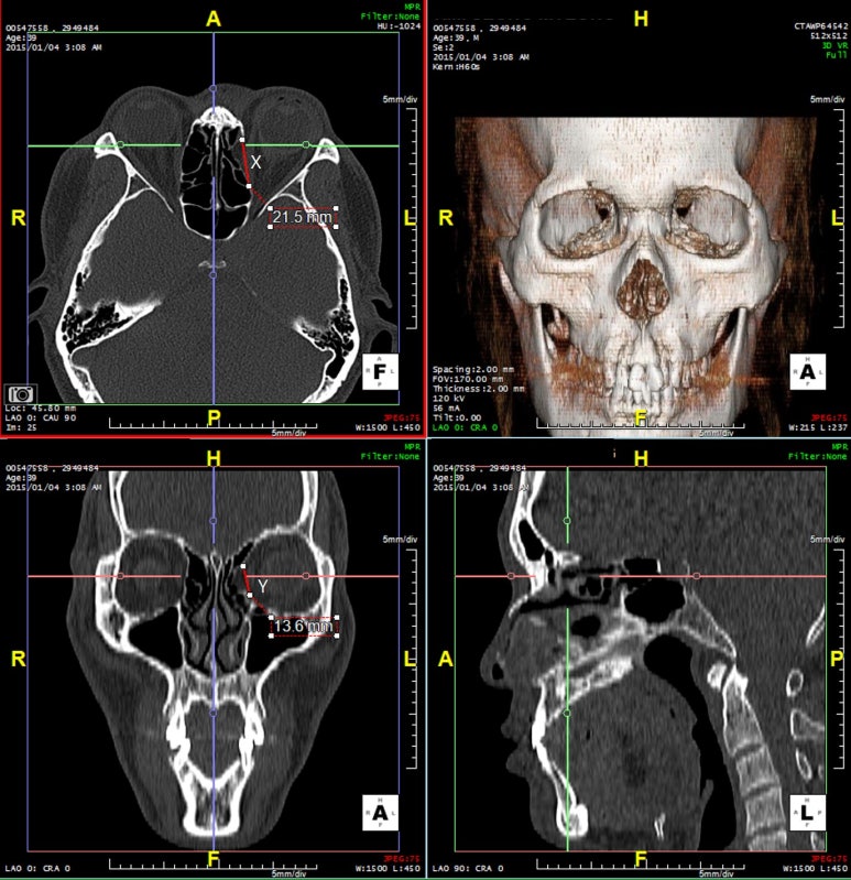 JPRAS-Prediction of late enophthalmos using quantitative measures in isolated med. orbital wall Fx. 관련 이미지 2