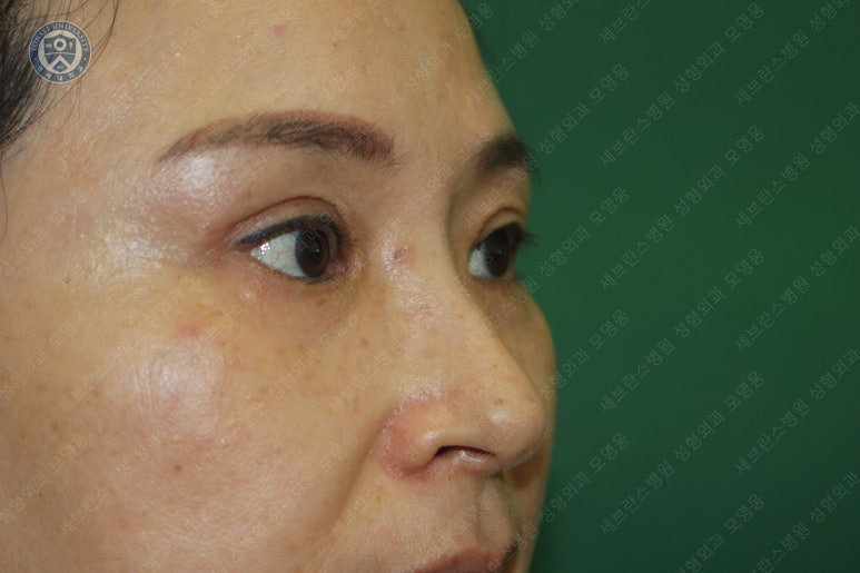 49세 여성, 토안이 있는 중년여성의 상안검성형술 (49/F, Upper blepharoplasty with lagophthalmos correction& LP) 관련 이미지 30