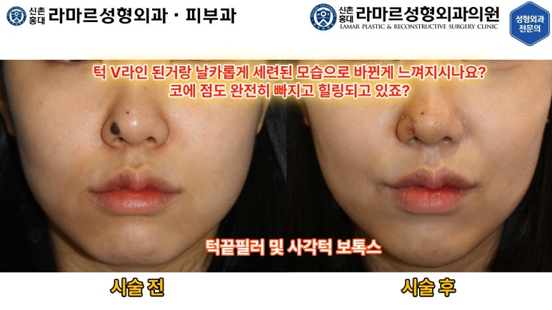 지름 1cm 코 점 제거수술 : 나선피판술(Spiral Flap) 수술전~1달 경과. (Feat. 턱끝필러+사각턱 보톡스) 관련 이미지 113