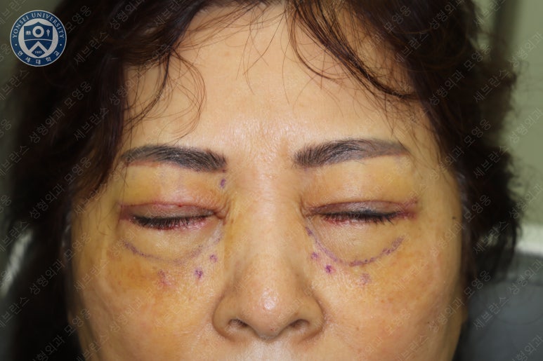 60세 여성, 상안검 및 하안검 성형술 증례 (60/F Upper & lower blepharoplasty) 관련 이미지 13