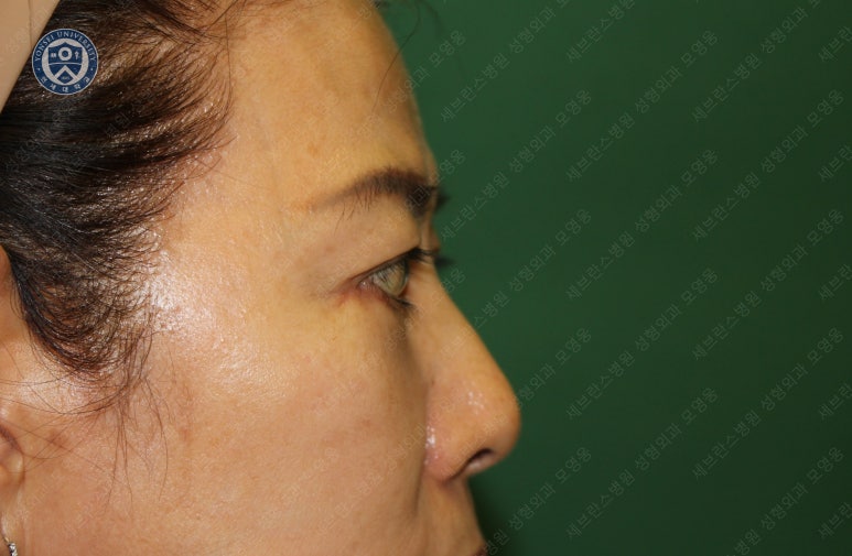 59세 여성, 그레이브스 안병증이 있는 돌출눈 중년 여성 하안검 성형술 (Lower blepharoplasty in Graves 관련 이미지 24
