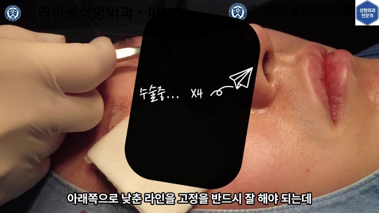 29세 남자, 소시지 쌍꺼풀 두줄따기로 낮추기 (쌍꺼풀 재수술) 관련 이미지 35
