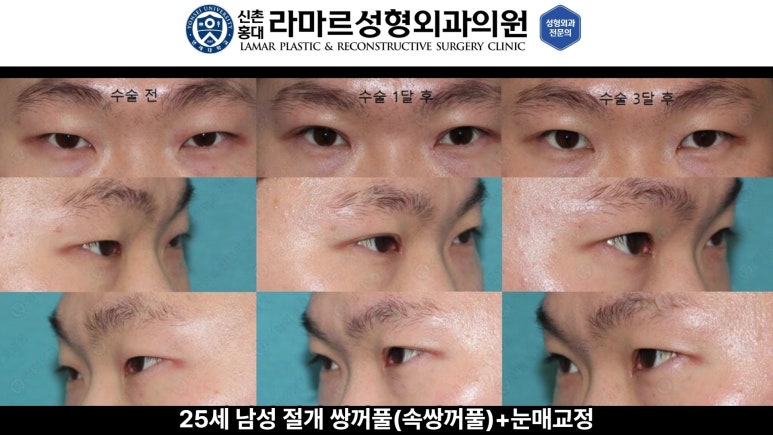 10대~30대 눈 수술 케이스 : 대표원장님 쌍꺼풀 전후 사진 모음 관련 이미지 6