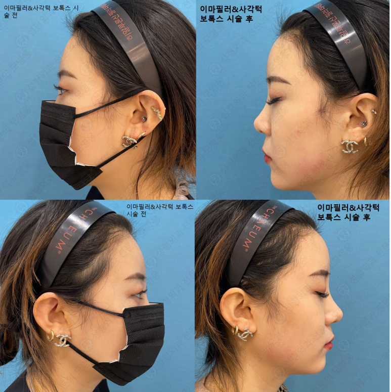 이마필러 : 21세 여성 이마필러 시술영상 관련 이미지 14