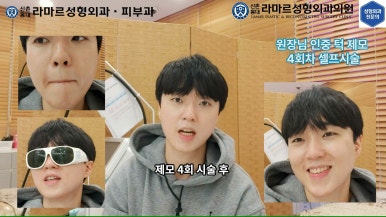 [성형외과 전문의의 셀프시술 제8편] 인중, 아래턱 제모 4회차 결과 공개! 관련 이미지 155