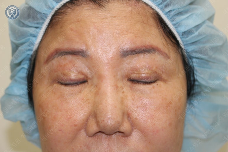 71세 여성, 이마거상술과 이마축소술 (71/F, Forehead lift and reduction) 관련 이미지 13