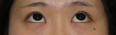 17세 여성, 쌍꺼풀+앞트임(DEO+Medial epicanthoplasty) 관련 이미지 31