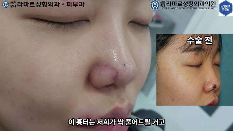 21세 여성 코 지름 1cm 점 제거수술 : 나선피판술(Spiral Flap) 수술전~5달 경과. (+쌍꺼풀수술, 코필러) 관련 이미지 21