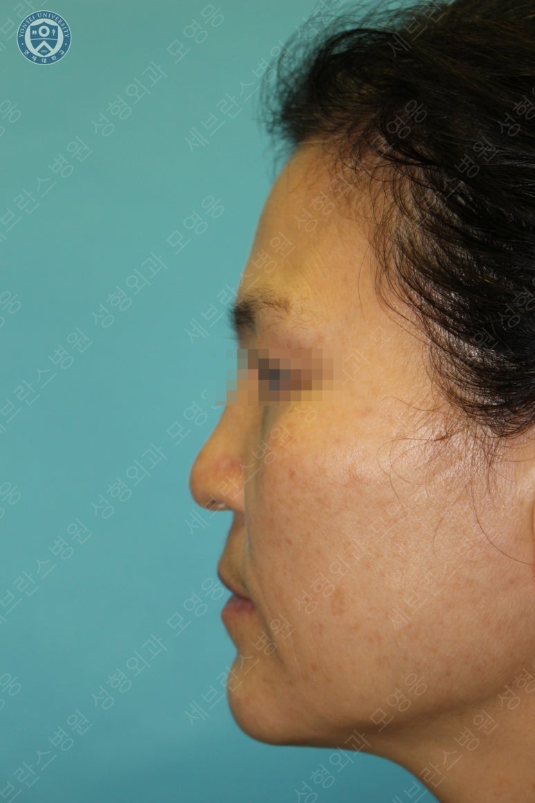 55세 여성, 이중평면 안면거상(55/F, Dual-plane full facelift) 관련 이미지 7