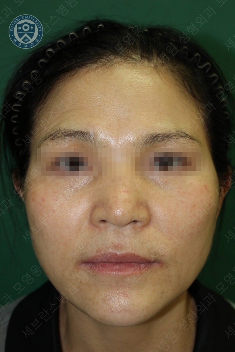 55세 여성, 이중평면 안면거상(55/F, Dual-plane full facelift) 관련 이미지 50