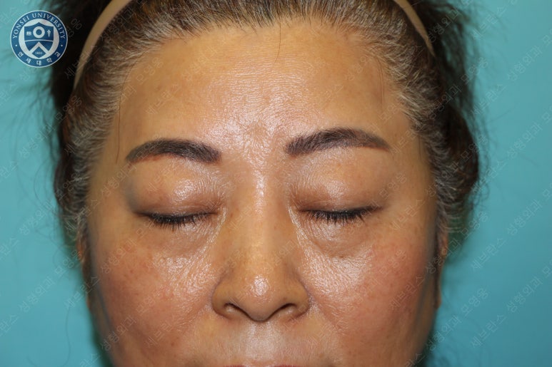 60세 여성, 상안검 및 하안검 성형술 증례 (60/F Upper & lower blepharoplasty) 관련 이미지 4