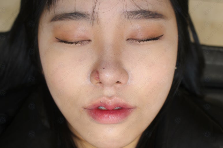 지름 1cm 코 점 제거수술 : 나선피판술(Spiral Flap) 수술전~1달 경과. (Feat. 턱끝필러+사각턱 보톡스) 관련 이미지 186