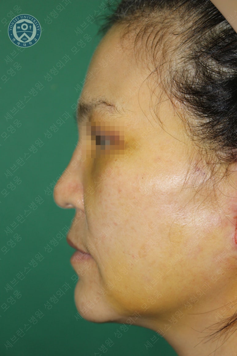 55세 여성, 이중평면 안면거상(55/F, Dual-plane full facelift) 관련 이미지 18