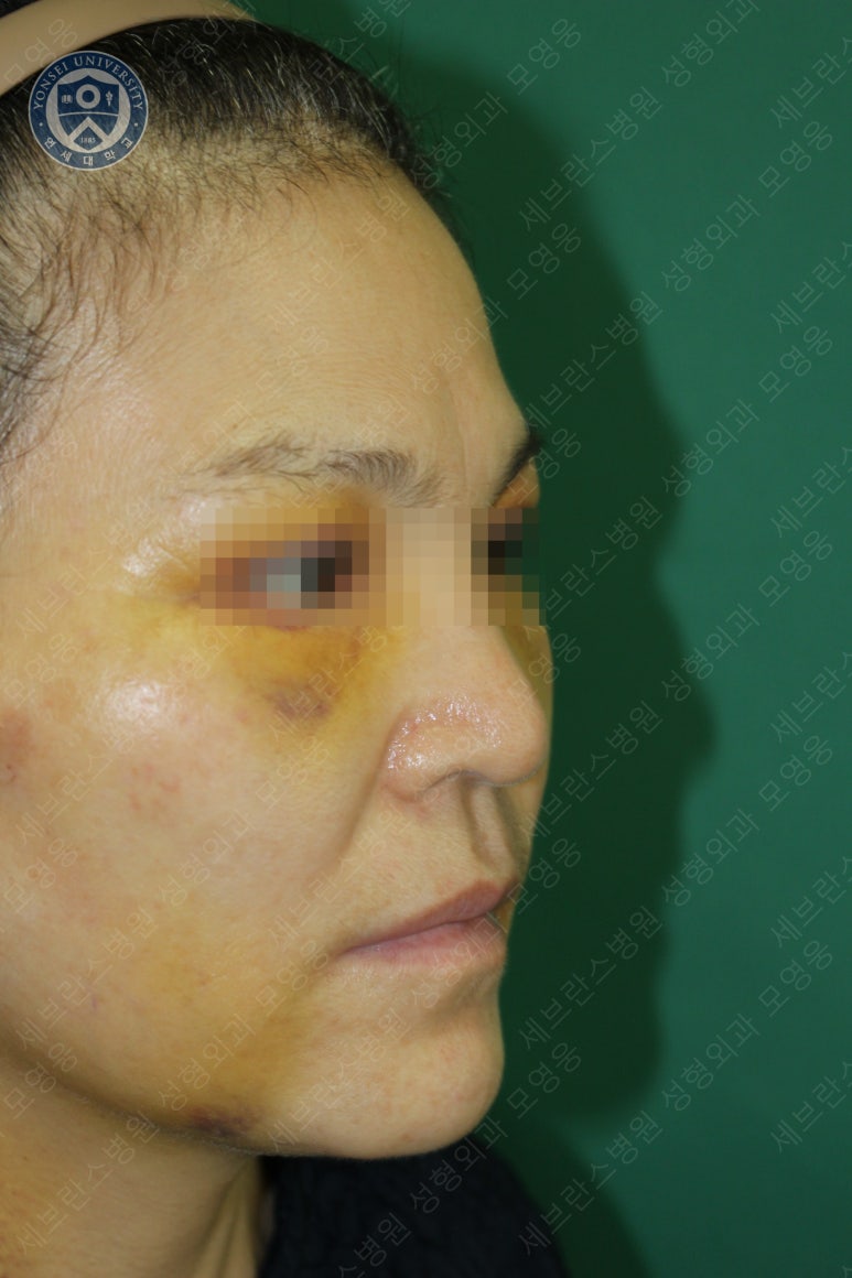 55세 여성, 이중평면 안면거상(55/F, Dual-plane full facelift) 관련 이미지 20