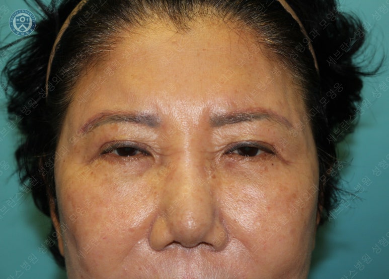 71세 여성, 이마거상술과 이마축소술 (71/F, Forehead lift and reduction) 관련 이미지 4