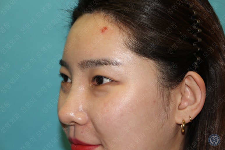28세 여성 두줄따기, 눈밑지(28/F D.E.O & transconjunctival septal fat redraping) 관련 이미지 7