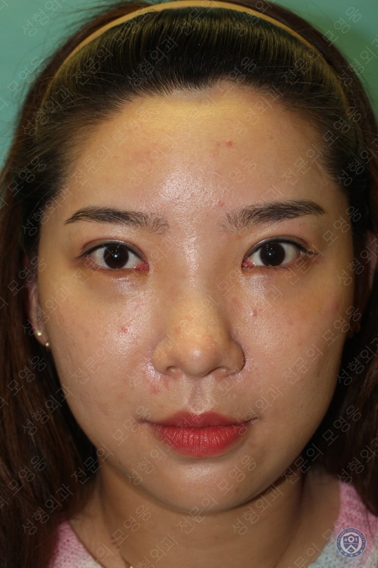 28세 여성 두줄따기, 눈밑지(28/F D.E.O & transconjunctival septal fat redraping) 관련 이미지 10