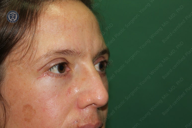 38세 서양 백인 여성, 쌍꺼풀 수술과 눈매교정 및 하안검성형술 (38/F Upper&lower blepharoplasty with levator plication) 관련 이미지 35