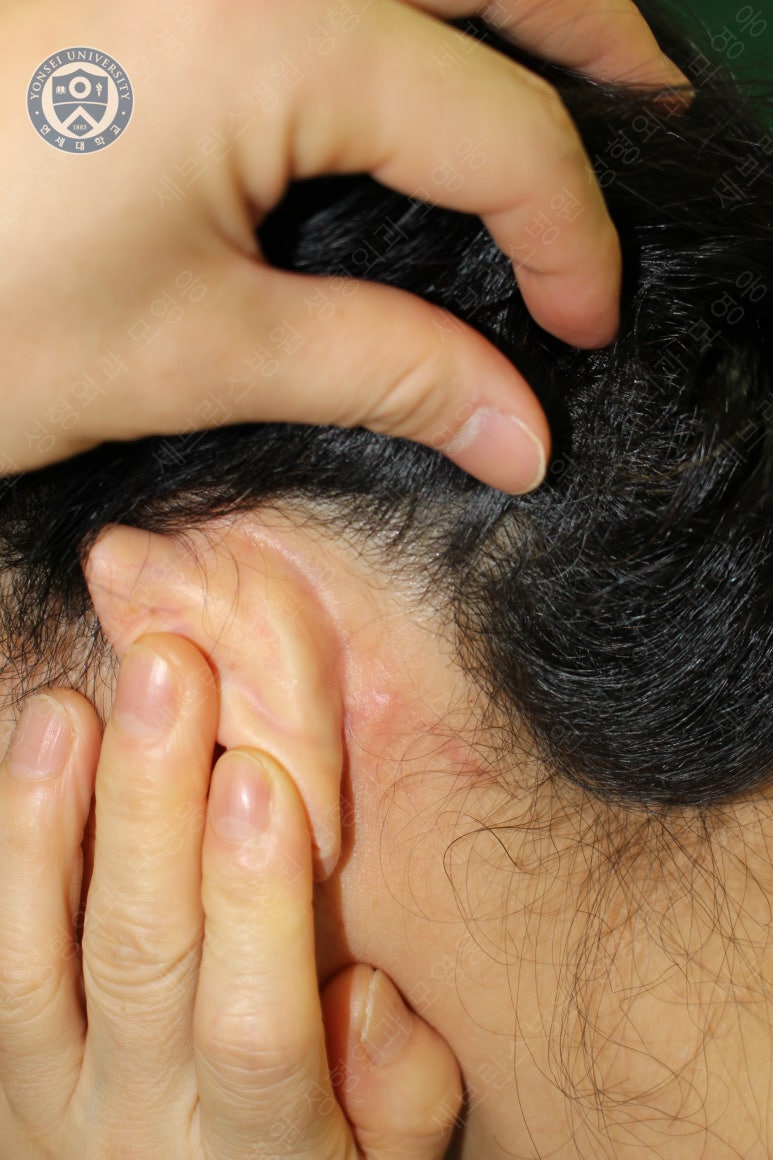 55세 여성, 이중평면 안면거상(55/F, Dual-plane full facelift) 관련 이미지 57
